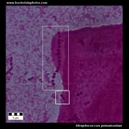 pneumococcus in sputum microscopy